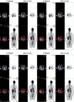 Achieving complete remission in metastatic hepatocellular carcinoma with sintilimab plus sorafenib therapy followed by hepatic resection: a case report